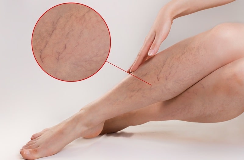  دكتور دوالي الساقين في دبي- عيادة دوالي في دبي-علاج الدوالي بالليزر 