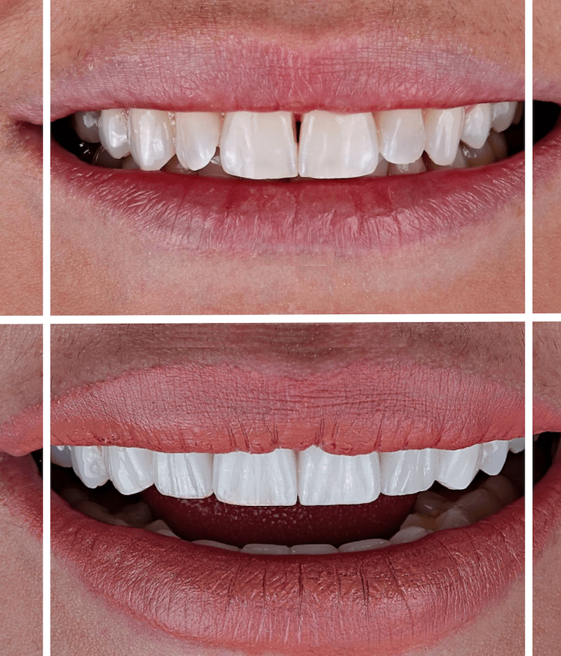 فينير الاسنان في قطر - افضل دكتور ابتسامة هوليود في جدة