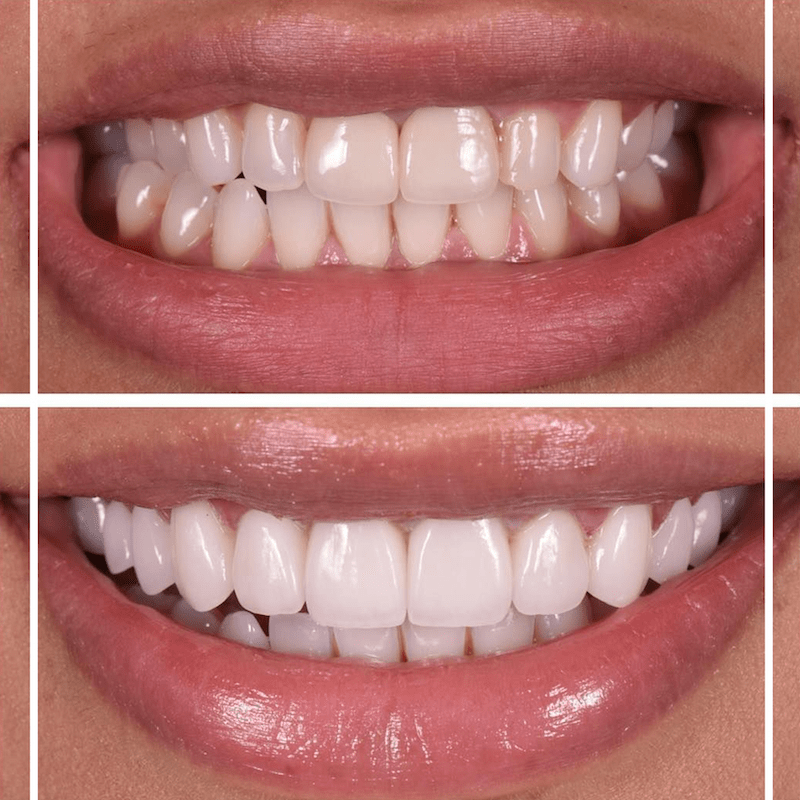 فينير الاسنان في قطر - افضل دكتور ابتسامة هوليود في جدة