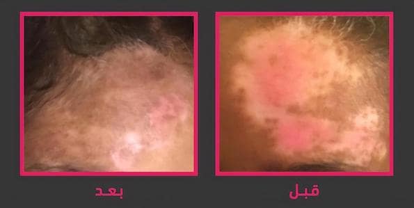 علاج البهاق في جدة