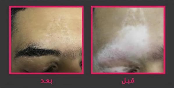 علاج البهاق في جدة