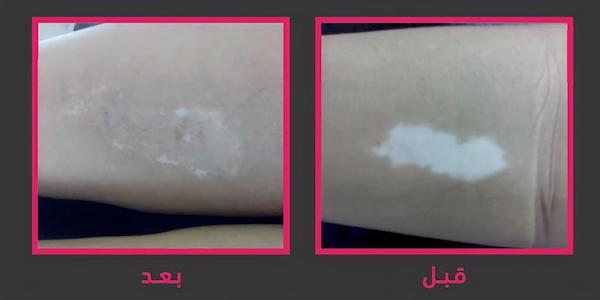 علاج البهاق في جدة