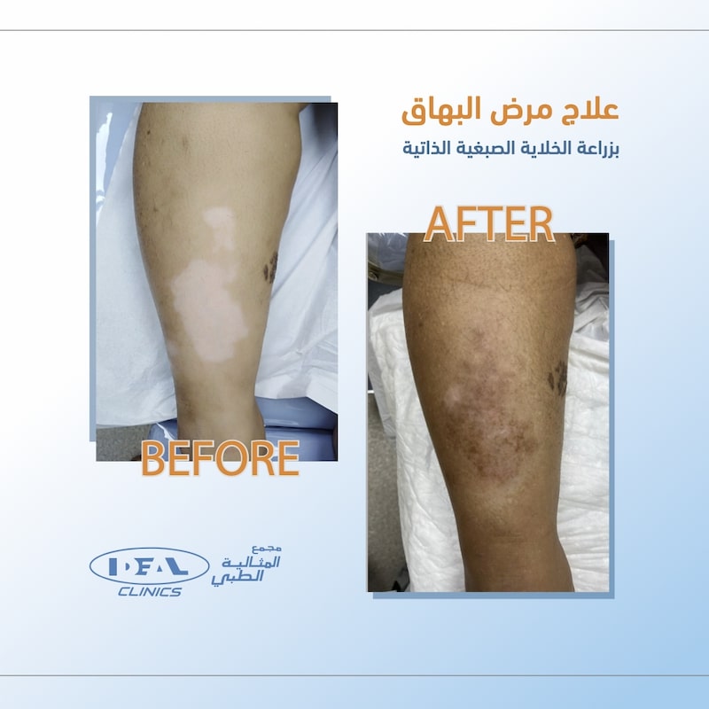 علاج البهاق في جدة