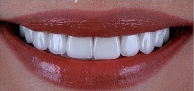 افضل دكتور ابتسامة هوليود في دبي، فينير الاسنان في دبي، عيادة تجميل الأسنان
