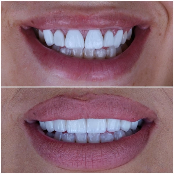 افضل دكتور ابتسامة هوليود في دبي، فينير الاسنان في دبي، عيادة تجميل الأسنان