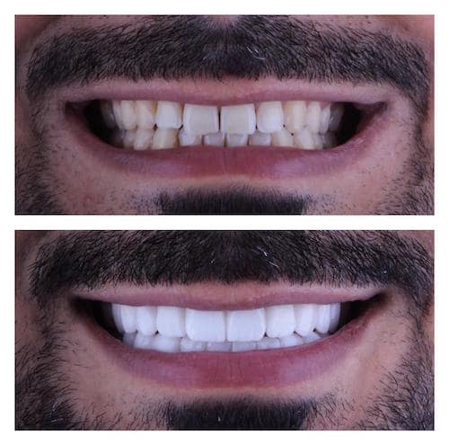 افضل دكتور ابتسامة هوليود في دبي، فينير الاسنان في دبي، عيادة تجميل الأسنان