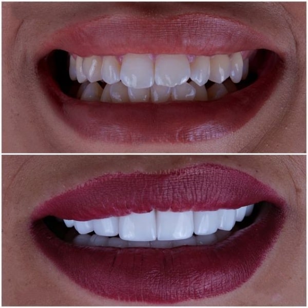 افضل دكتور ابتسامة هوليود في دبي، فينير الاسنان في دبي، عيادة تجميل الأسنان