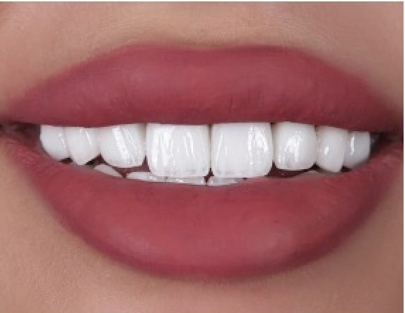 افضل دكتور ابتسامة هوليود في دبي، فينير الاسنان في دبي، عيادة تجميل الأسنان