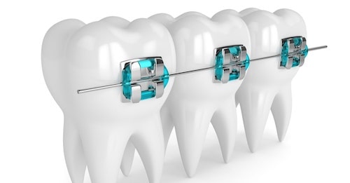 تقويم الأسنان في العين