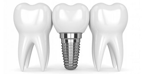 زراعة الأسنان في العين