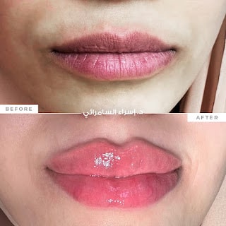 فيلر في الشارقة