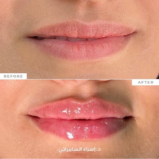  تقنية فيلر تكساس لتحديد الوجه و الذقن