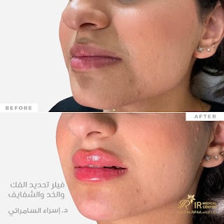  تقنية فيلر تكساس لتحديد الوجه و الذقن